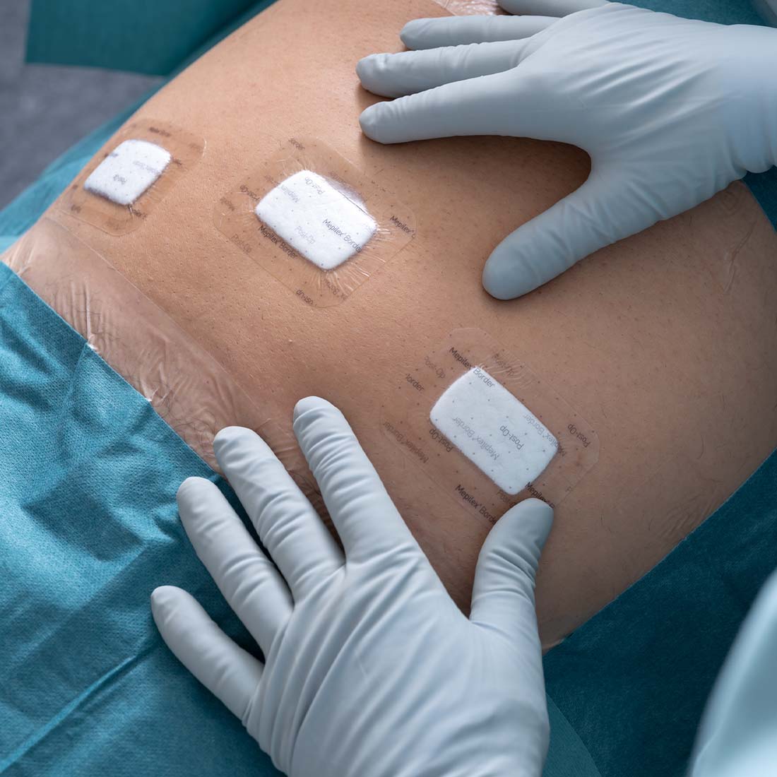 Curativo Pós-operatório Mepilex Border  Post-Op 10x15 Unidade - Imagem 7