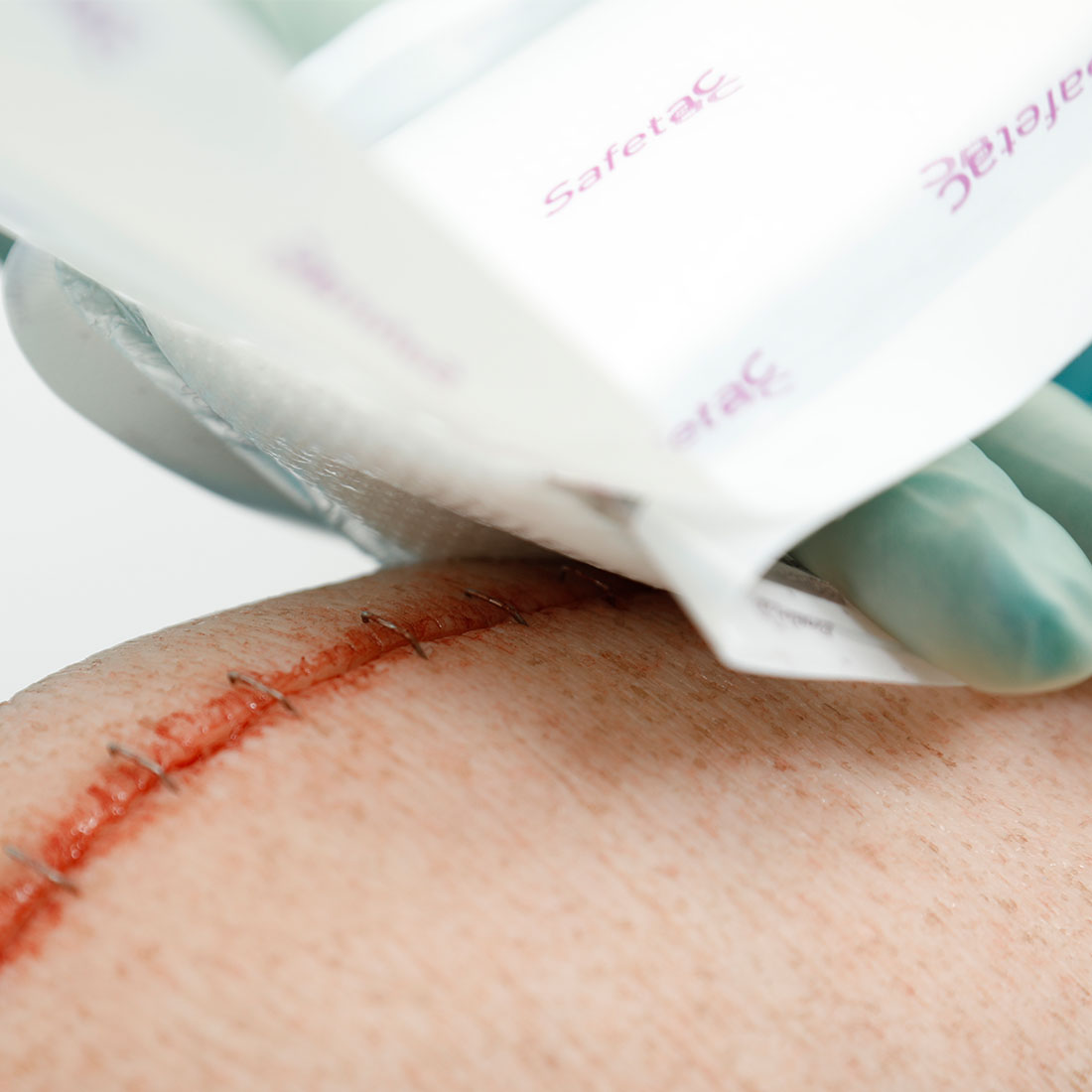 Curativo Pós-operatório Mepilex Border Post-Op 10x20 Unidade - Imagem 2